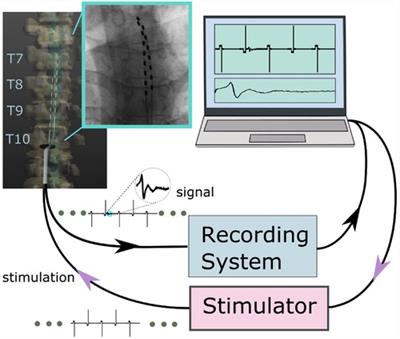 Methods and system for recording human physiological signals from implantable leads during spinal cord stimulation